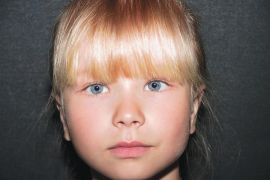 Ohren anlegen Bild nach OP 4